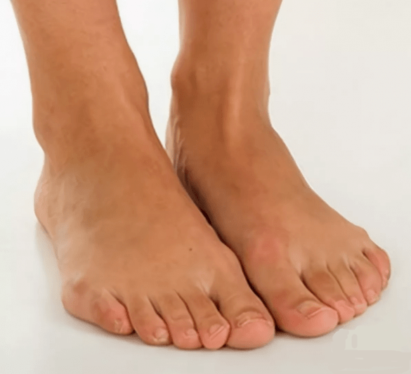 Υγιή πόδια μετά από θεραπεία με σπρέι Hondrox