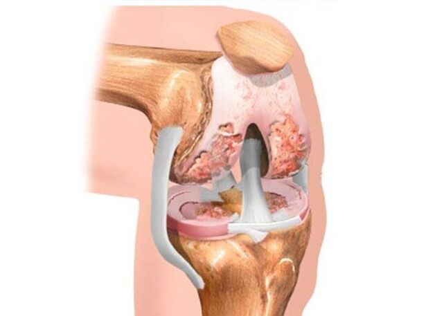 Οστεοαρθρίτιδα γόνατος