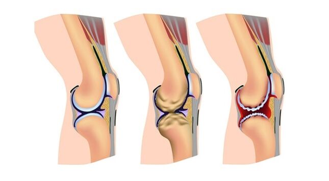 Στάδια οστεοαρθρίτιδας της άρθρωσης του γόνατος
