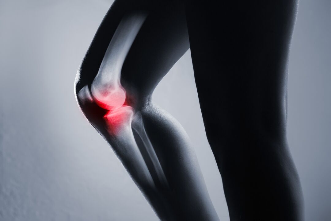 Φλεγμονή της άρθρωσης του γόνατος με οστεοαρθρίτιδα